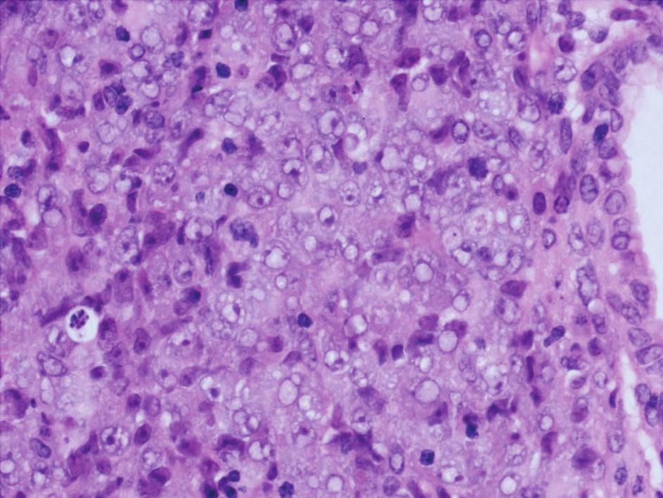 relapse AML, 13 mesiacov od stanovenia diagnózy.