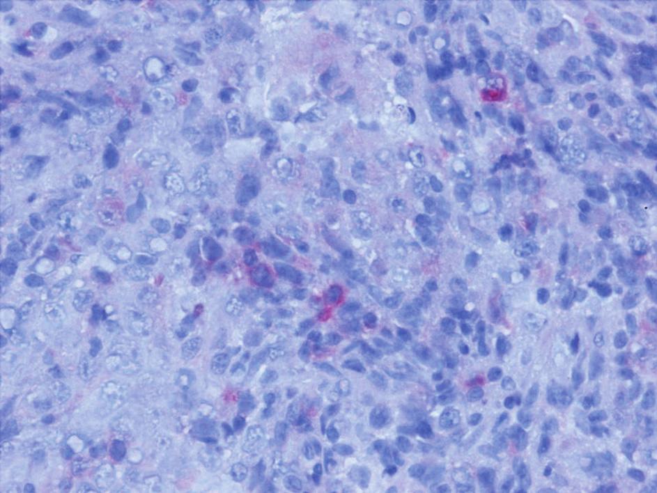 pozitivite CD56 (22, 25, 26).