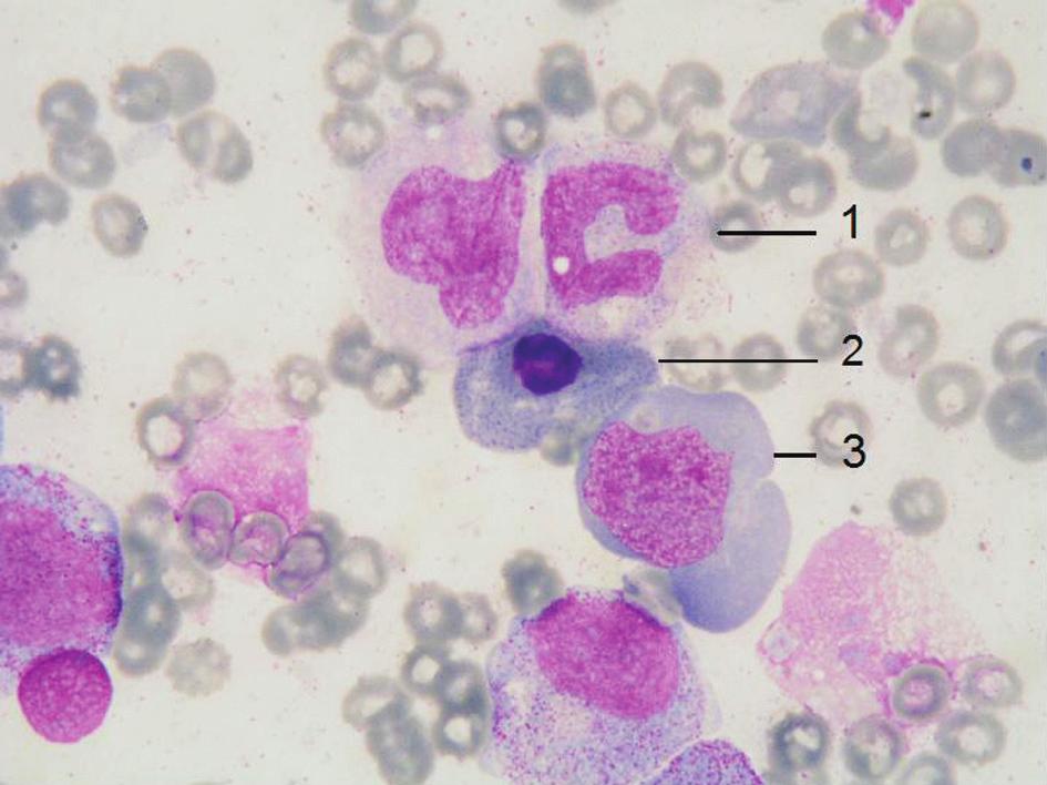 PAPOUŠEK P. ET AL. Tab. 2. Nález v krevním nátěru a kostní dřeni u megaloblastové anémie.