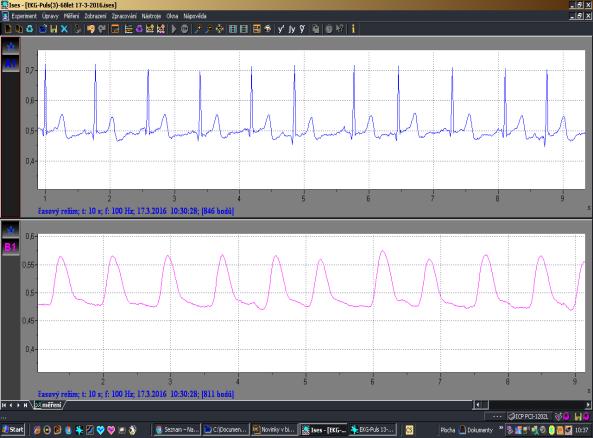 stopa EKG (modře), dole 2. stopa KTG karotidogram snímaný z krční tepny krkavice (fialově).