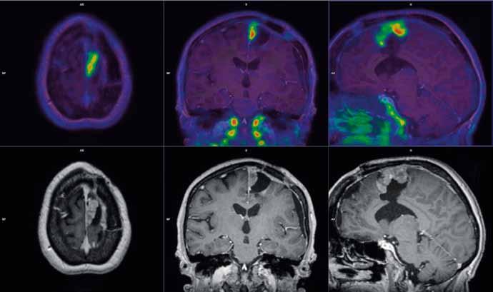 Ces Radiol 2016; 70(4): 205 2 Obr. 4 Obr. 4. F -FLT-PET/MR: rekurentní vysokostupňový anaplastický astrocytom po resekci s vysokou akumulací FLT, která ukazuje na vysokou proliferační aktivitu ve tkáni Fig.