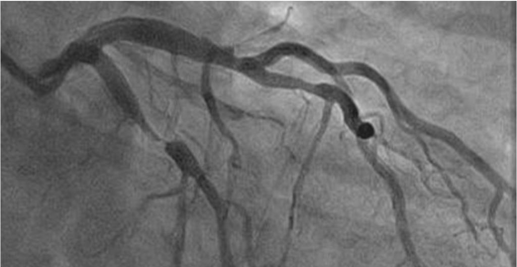 Coronary