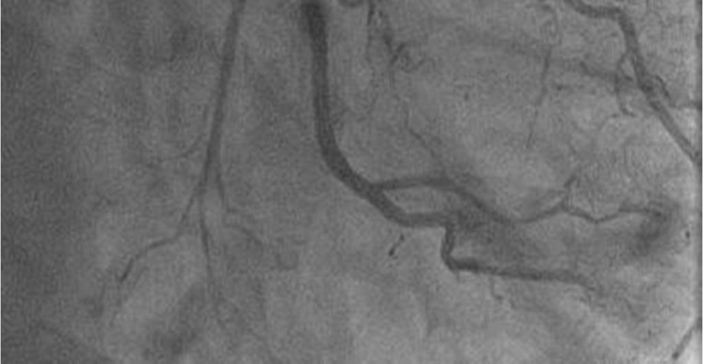 coronary angiogram