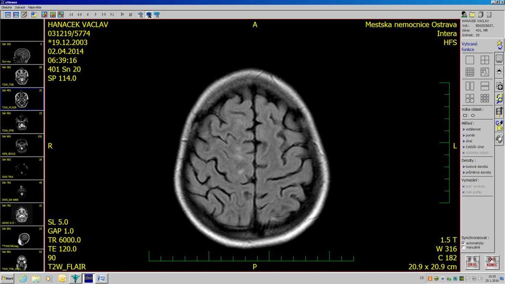 T2W low signal areas of both thalamus, discrete high signal areas in white mater juxtacortcal and frontal on the right