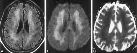 Pozdní neuropsychické postžení v řádu dnů až měsíců (3-240 dnů, průměr 20 dnů) po otravě u 15-40% zdánlivě uzdravených trvá i déle než 1 rok, 75% případů odezní zcela nebo s minimálními následky