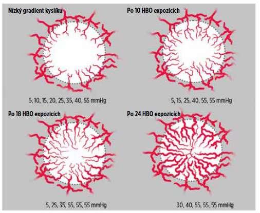 Rlst kapilár v závislost na počtu expozic HBO na modelu tkáně s radiačním poraněním Upraveno podle: Marx R: Radiation injury to tissue.