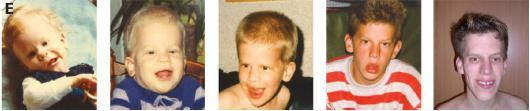 DeVries syndrom
