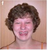 Diagnóza stanovena 2009, v té době již popsaný, ale