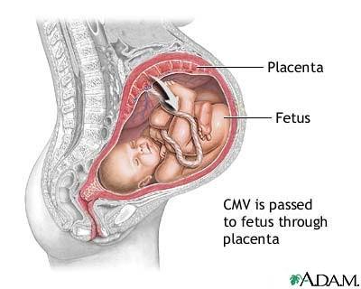 CYTOMEGALOVIROVÁ INFEKCE Přenos choroby: přímým kontaktem, včetně sexuálního styku či sekrety,z matky na dítě intrauterinně, během porodu i po porodu mateřským mlékem, přenos transfúzí krve a