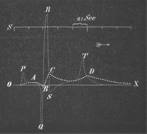 EKG -