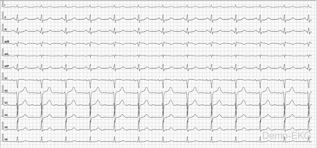 EKG 12