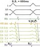 Základy elektrofyziologického vyšetření 4 Obr. 4.7 Koncentrická aktivace síní při sériové stimulaci pravé komory S 1 S 1 600 ms.