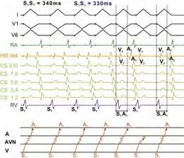 4 Základy srdeční elektrofyziologie a katétrových ablací Obr. 4.8 Vzestupná stimulace komor Sériová stimulace o délce cyklu 340 ms vede k retrográdnímu vedení komory síně v poměru 1 : 1.