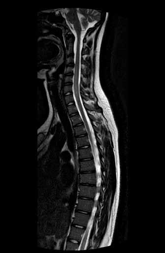 Sagittal T2-weighted magnetic resonance imaging of the spine showing hyperintensive lesions. Fig. 1A) Multiple lesions in a patient with multiple sclerosis. Fig. 1B) Longitudinaly extensive myelitis in a patient with neuromyelitis optica spectrum disorder.