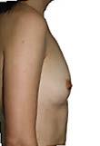 příblížil vašemu přání ohledně výsledného vzhledu prsou, využívá širokou paletu velikostí Motiva implantátů a také vybírá, který implantát zvolí