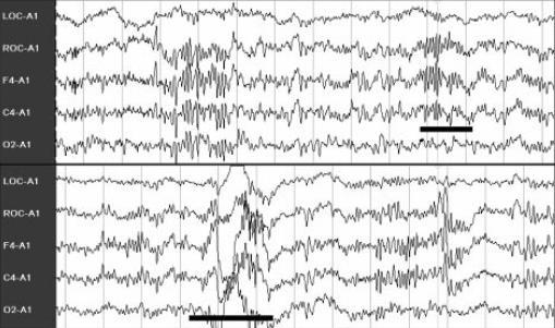 Obrázek 2.2 Ukázka spánkových vřeten (nahoře) a K-komplexu (dole) [17] 2.2. Elektromyografie Ačkoliv je EEG bezesporu nejdůležitějším signálem pro klasifikaci spánkových fází, další měřené parametry výrazně přispívají k přesnosti klasifikace.