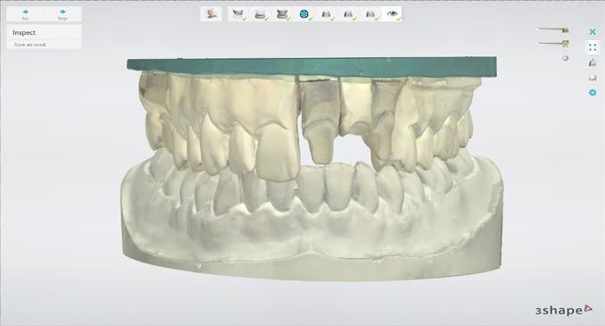 Skenování Snadné přidání dalších skenů modelů Rozsáhlá funkce Adaptivní skenování, která je nyní podporována nejen při skenování otisků, ale i