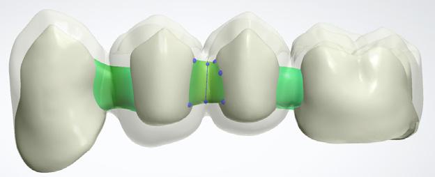 Funkce jednoduchého připojení k linii krčkového uzávěru je užitečná, zejména pokud je možnost návrhu na ovládacím panelu systému Dental System Automaticky připojit anatomickou