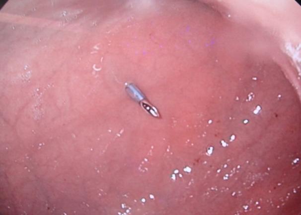 endoskopem (mimo