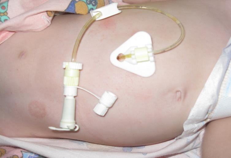 Perkutánní endoskopická gastrostomie Definice: umělé