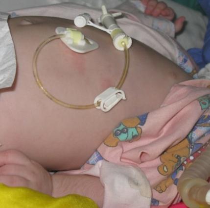 Indikace zavedení PEGu nedostatečný nutriční příjem a růst dítěte bez perspektivy zlepšení v krátké době (4-6 týdnů) neurologická onemocnění, cystická fibróza, dědičné metabolické poruchy,