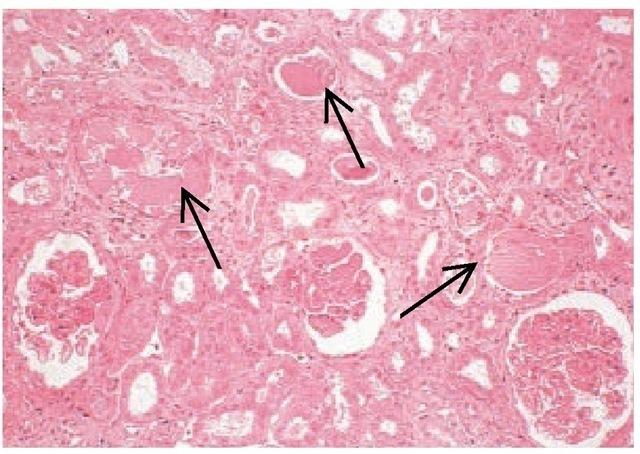 cast nephropathy (CN) CN ( myelomová ledvina) vzniká nadprodukcí FLC, maligními pl.b. a ledvinami nestačí být vylučovány a tak v tubulech precipitují (n<300mg/l, u MM > 20g/ den).