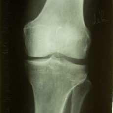 3. EPIDEMIOLOGIE OSTEOARTRÓZY K tomu, aby mohl být stanoven skutečný výskyt OA, je třeba sjednotit definici diagnostických kritérií pro toto onemocnění.