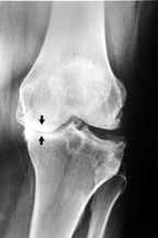 [17][29] Patologicko-anatomická definice OA: Jde o destrukci chrupavky, která je spojena se změnami subchondrální kosti, kde dochází v místech zvýšeného tlaku k mikrofrakturám a tvorbě cyst.