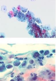 adenokarcinomy 2 senzitivita 40 75% 1. Castle PE, et al.