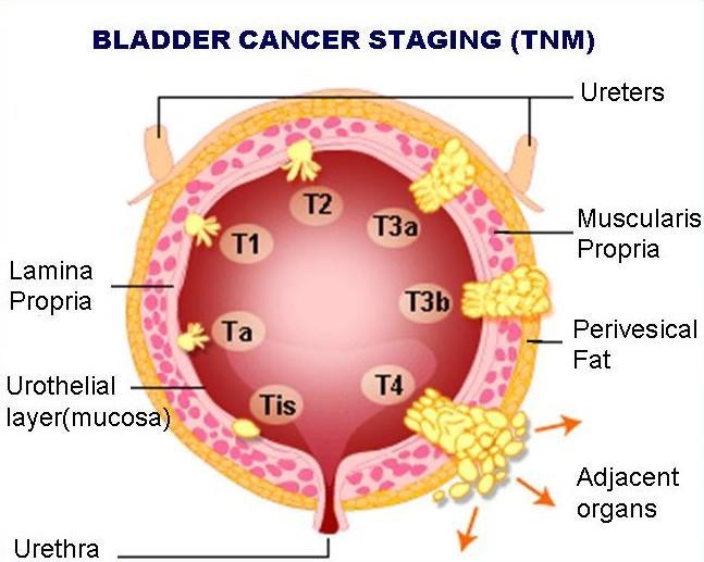 Diagnostika Cystoskopie zlatý standard UZ Senzitivita 95% při naplněném m.m. Při nálezu tumoru rovnou resekce Cytologie moči senzitivní na high-grade CT urografie u invazivních po TURT Lok.