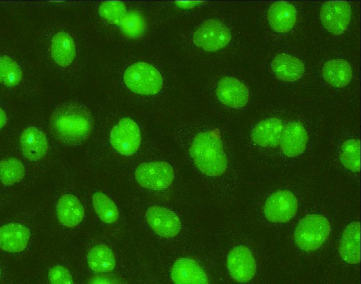 Falešná pozitivita Scl-70 Sérum s pozitivitou anti ds DNA Ab přítomny imunitní komplexy DNA anti-ds DNA Scl-70
