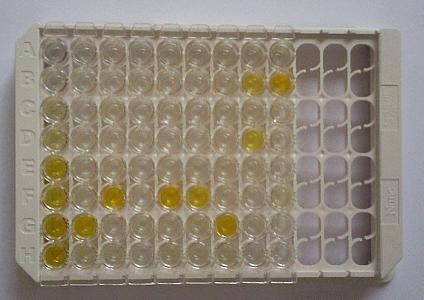 Anti ds DNA protilátky X Antinukleozomové protilátky - ELISA Anti dsdna Ab: ANA Hep-2 negativní, ELISA antidsdna pozitivní Nespecifická vazba imunoglobulinu, falešně pozitivní výsledky Anti-TNF
