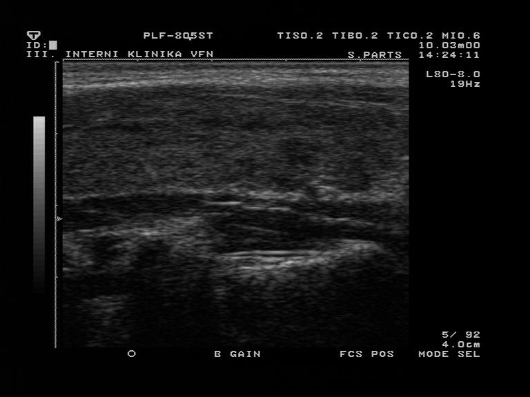 Aplikace : Hledání informativních příznaků pro rozpoznávání Sonogram štítné žlázy v podélném řezu zdravá lymfocitická thyroitida Zajímá nás, kolik se lze z dat