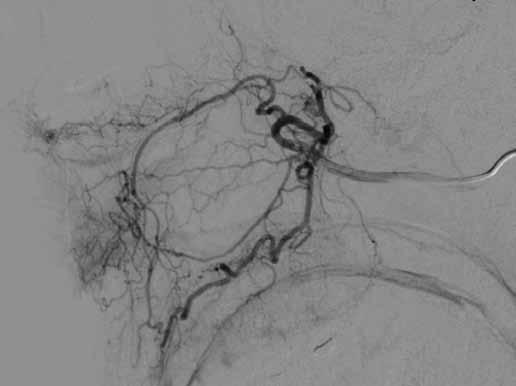 Obr. 2A Obr. 2B Obr. 2A,B. Selektivní angiogram terminálního větvení AMI před a po embolizaci Fig. 2A,B. Selective angiogram of terminal branches of the AMI before and after embolization z povodí ACE.