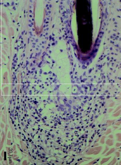 Obr. 6: Histologický obraz mazové žlázy se zánětlivou reakcí (Reichler, a kol., 2001) Tyto takzvané obranné buňky byly reprezentované makrofágy, lymfocyty a neutrofilními granulocyty.