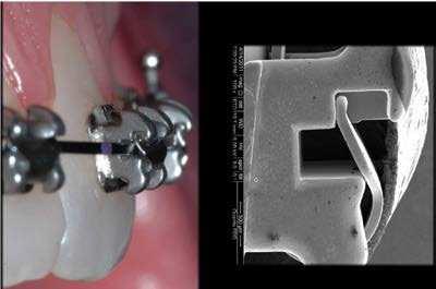 Přehled klinické ortodoncie: Mechanika léčby, část I. Autor: Antonino G. Secchi, DMD, MS Obr.