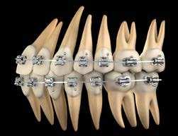 Obr. 3: Ukazuje systém CCO s hodnotami torze, angulace a offset pro každý zub Obr.