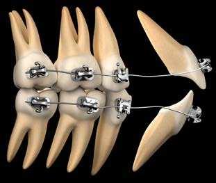 a 2. Oblouk.020.020 Bioforce upravuje většinu rotací zubů zbylých po úvodní nivelizaci, díky své rigiditě začíná s vyrovnáním Speeovy křivky, čímž dochází k oplošťování okluzní roviny.