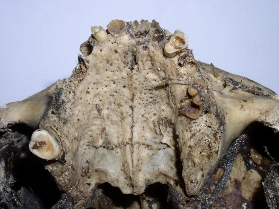 Ztráta kosti v souvislosti s alveolární sesorbcí zahrnuje 4 součásti čelistí: alveolární výběžky, vnější kortikální povrch na bukální a linguální straně a pod ní ležící kost.