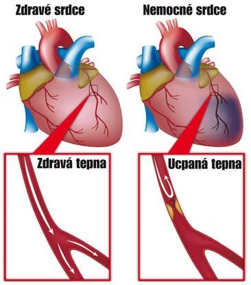 Obrázek 5: Vznik infarktu myokardu. 2.3.5 Aortální aneurysma Aneurysma nebo také výduť je rozšíření aorty. Tento stav je velice nebezpečný pro člověka.