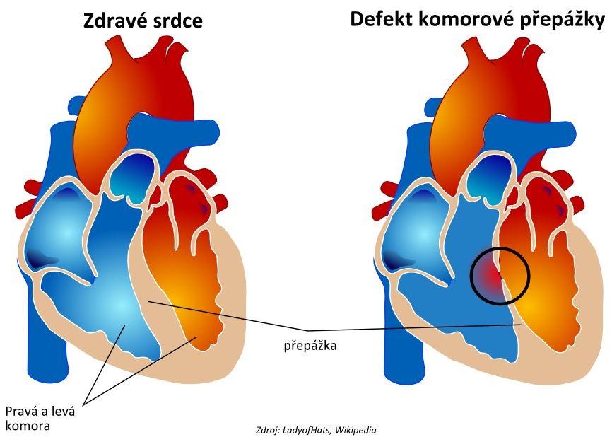 Vrozené srdeční vady způsobí znemoţnění klasického průtoku krve srdcem.