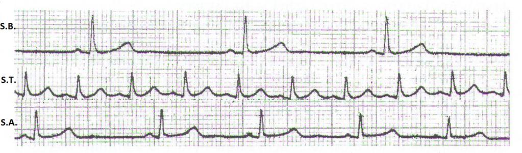 Obrázek 8: Záznam EKG se