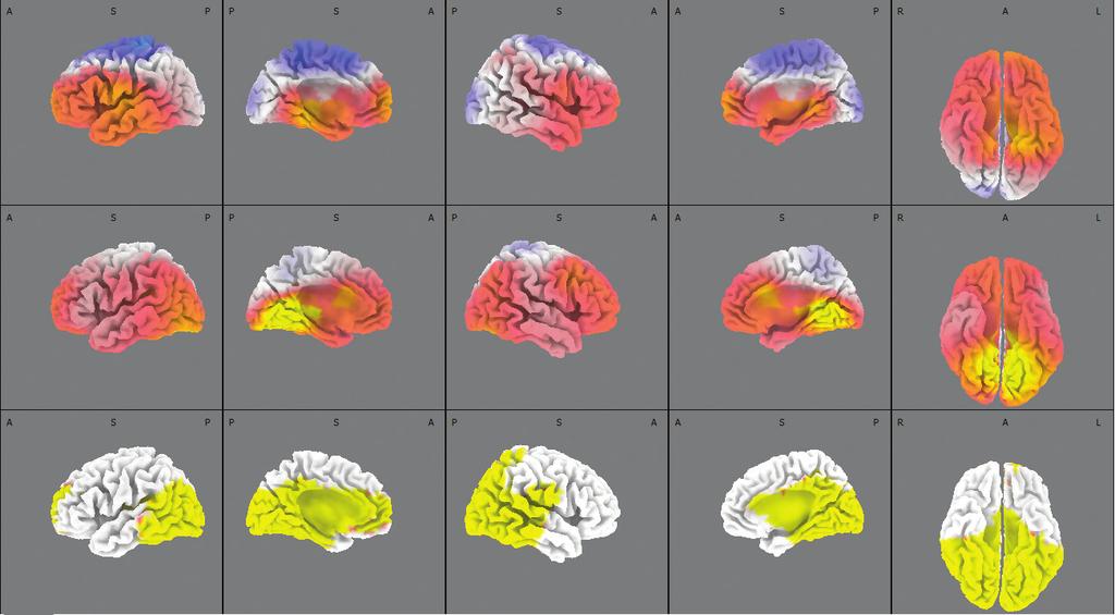 PSYCHIATRIE ROÈNÍK 12 2008 ÈÍS LO 3 Mozek funkènì morfologické nálezy v psychiatrii 1 týden 4 týdny 14 týdnů Obrázek 1: Distribuce proudové hustoty theta aktivity srovnáním po 1, 4 a 14 týdnech vs.