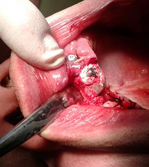 Při zavádění implantátů ihned po extrakcích např. v oblasti dolní fronty lze prostory mezi implantáty a lůžky alveolů vyplnit např.