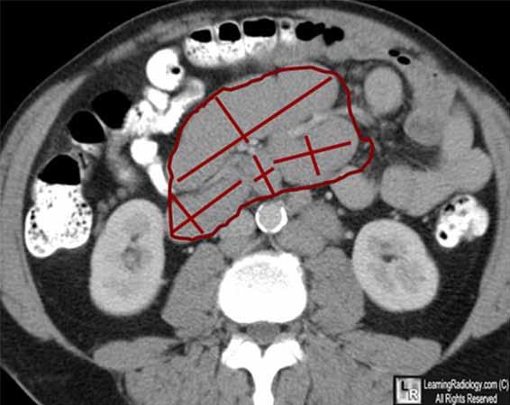(příklad: dle CT parciální remise, PET negativní, celkově tedy kompletní remise). Obr. 3. Měření rozpadu tumorózní masy na několik uzlinových lézí po léčbě.