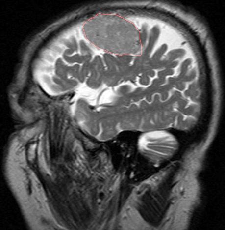 (a) (b) (c) (d) Obr. 5.22: Segmentace meningiomu na MRI (T2) snímku hlavy v sagitálním pohledu. (a) Značení bodů a oblastí. (b) Utvořená šablona. (c) Výsledný obrys. (d) Výsledek.