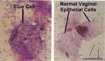 Clue cells http://www.kcom.