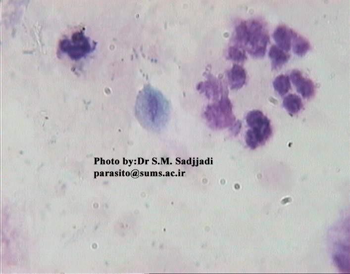 Trichomonóza (Giemsa)