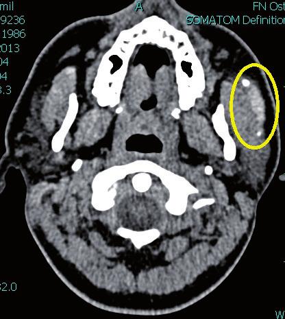 zánětu dilatace vývodu průkaz sialolitu ve vývodovém systému či žláze sialografi e diagnostika duktálních chronických zánětů slinných žláz, hlavně sialodochoektazií, tj.