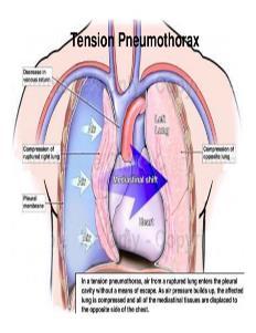 Tenzný pneumotorax tupé poranenie hrudníka poranenie pľúc zlomeným rebrom náhla decelerácia pľúcneho tkaniva barotrauma bez postihnutia rebier kombinácia s hemotoraxom ventilový